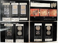 詰め物　値段表　価格表