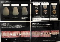 被せ物　値段表　価格表